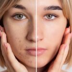 Acne: come combattere i brufoli con l’alimentazione