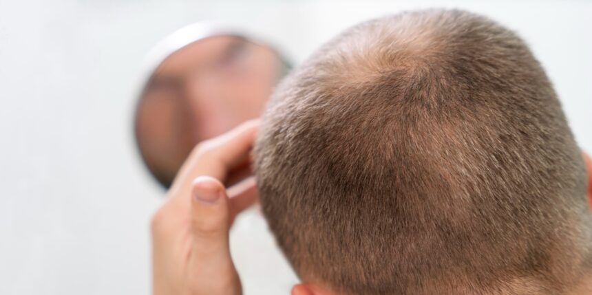 Chiazze sui capelli: quando si parla di alopecia areata