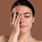 I rimedi per eliminare l’acne