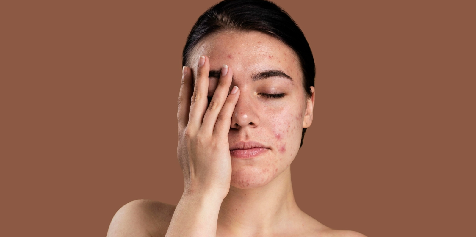 I rimedi per eliminare l’acne